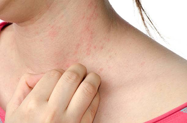 Dermatita Atopica Cauze Simptome Preventie Tratament Hot Sex Hot Sex Picture